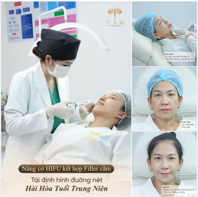 Khi HIFU kết hợp cùng Filler cằm, mỗi phương pháp sẽ phát huy đúng vai trò của mình để mang lại tổng thể gương mặt hài hòa hơn.
