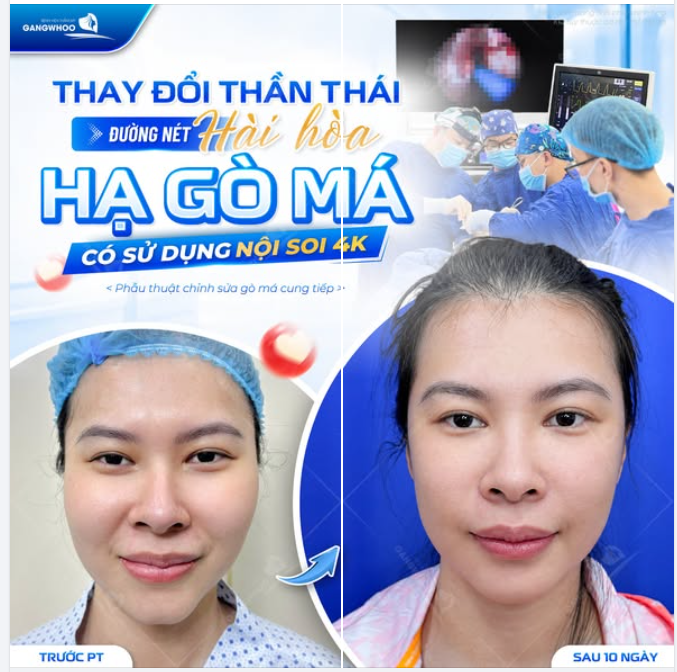 THAY ĐỔI THẦN THÁI - ĐƯỜNG NÉT HÀI HÒA - HẠ GÒ MÁ CÓ SỬ DỤNG NỘI SOI 4K