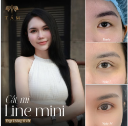 Trước làm chị T.Q gặp tình trạng mắt thiếu mỡ, hốc sâu và nhiều nếp mí phụ, khiến mắt già hơn tuổi.