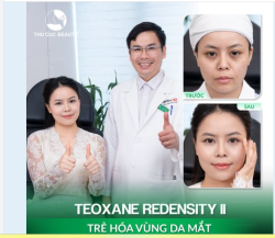 TEOXANE REDENSITY II – TÁI SINH ÁNH NHÌN RẠNG RỠ, TRẺ HÓA VÙNG DA MẮT CHUYÊN SÂU!