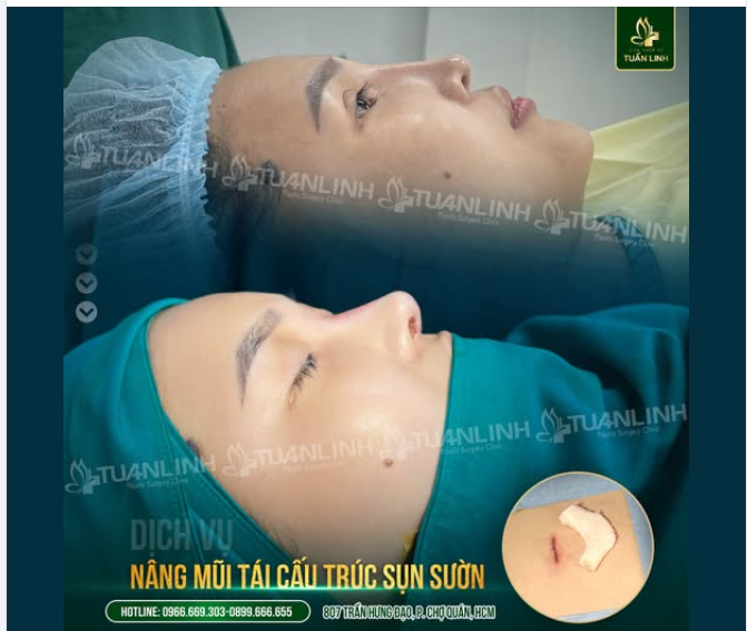 NÂNG MŨI SỤN SƯỜN – "CHÌA KHÓA VÀNG" CHO NHỮNG CA NÂNG MŨI KHÓ .
