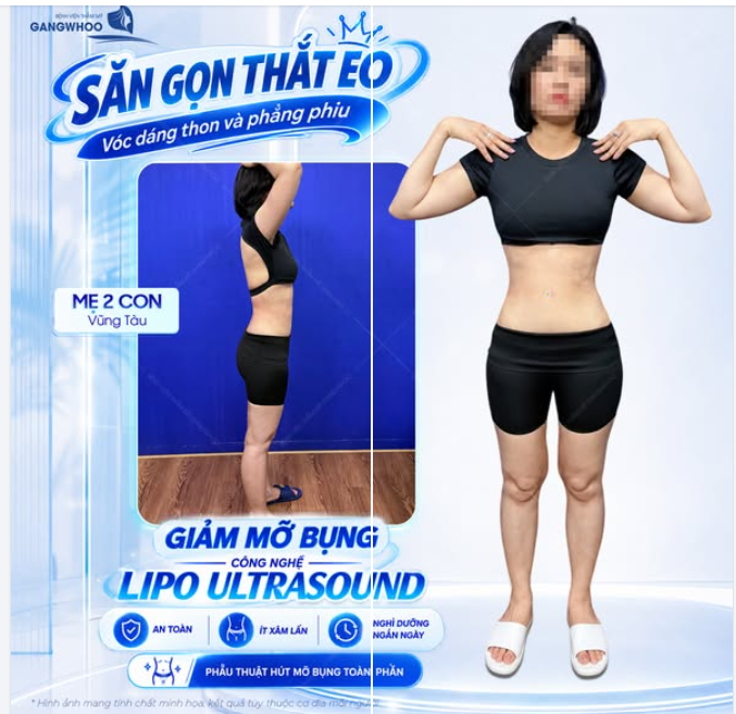 SĂN GỌN THẮT EO SAU GIẢM MỠ BỤNG