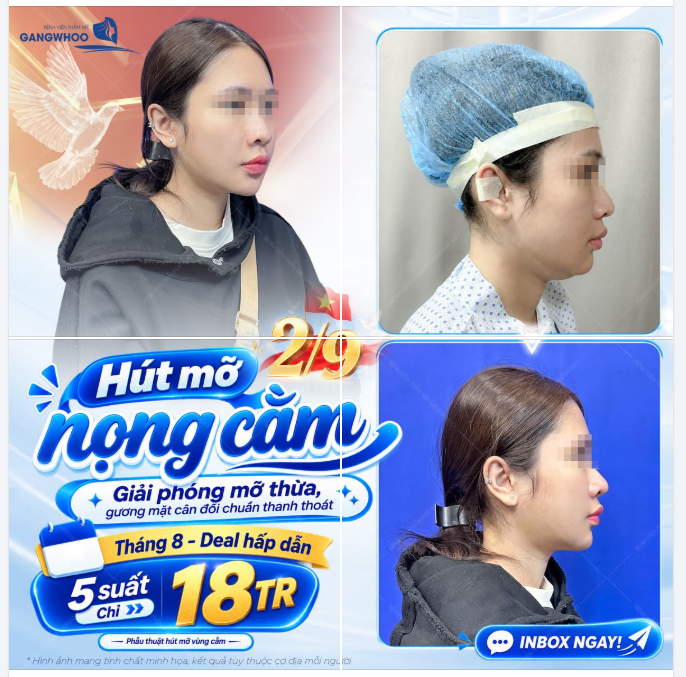 CẢI THIỆN ĐƯỜNG NÉT VÙNG CẰM – GƯƠNG MẶT HÀI HÒA HƠN