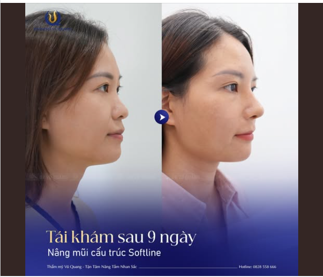 9 NGÀY SAU NÂNG MŨI – HÀNH TRÌNH TỪ NƯỚC MẮT XÚC ĐỘNG ĐẾN NỤ CƯỜI HẠNH PHÚC!