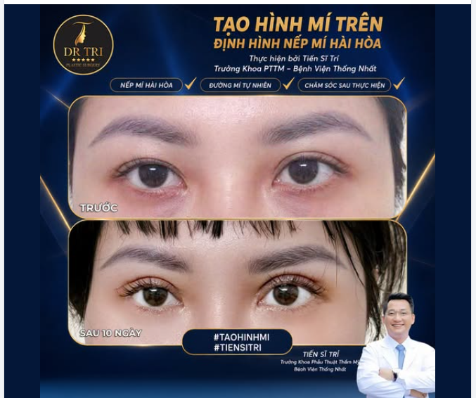 TẠM BIỆT MẮT SỤP, MÍ LÓT – ĐÓN ĐÔI MẮT 2 MÍ RẠNG RỠ!