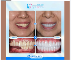 TẠI SAO TRỒNG RĂNG IMPLANT LÀ PHƯƠNG PHÁP PHỤC HỒI RĂNG MẤT TOÀN DIỆN?