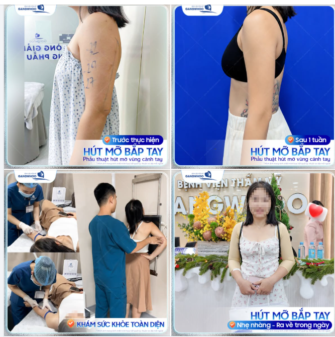 BẮP TAY THON GỌN NHẸ NHÀNG TẠI GANGWHOO