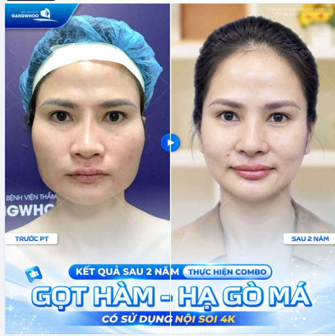 KẾT QUẢ SAU 2 NĂM THỰC HIỆN COMBO GỌT HÀM - HẠ GÒ MÁ CÓ SỬ DỤNG NỘI SOI 4K