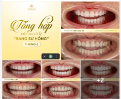 TẠM BIỆT NỖI LO SỨ HỎNG - TỔNG HỢP NHỮNG CA PHỤC HỒI NỤ CƯỜI THÁNG 8 TẠI WIN SMILE