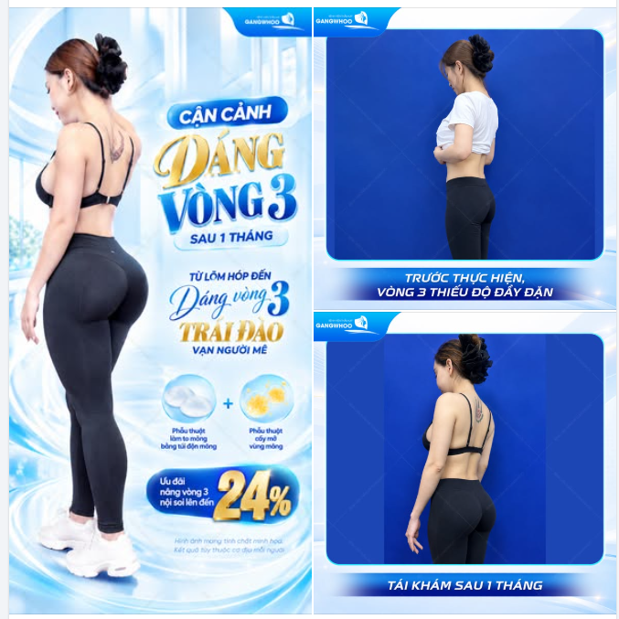 CẬN CẢNH DÁNG VÒNG 3 SAU 1 THÁNG - TỪ LÕM HÓP ĐẾN DÁNG VÒNG 3 TRÁI ĐÀO VẠN NGƯỜI MÊ