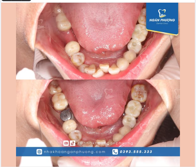 Phục hình răng 46 trước nghỉ lễ cho cô Hồng Gấm