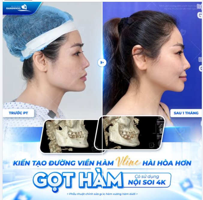 KIẾN TẠO ĐƯỜNG VIỀN HÀM VLINE HÀI HÒA HƠN - GỌT HÀM CÓ SỬ DỤNG NỘI SOI 4K