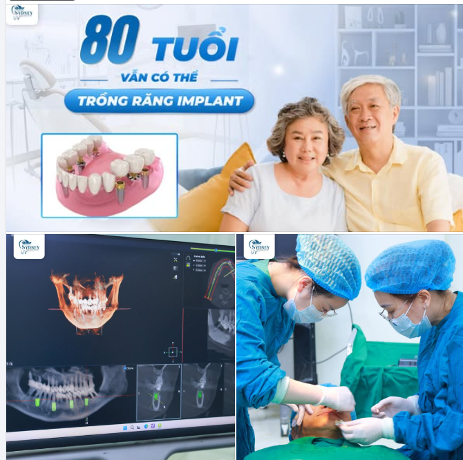 80 TUỔI VẪN CÓ THỂ TRỒNG RĂNG IMPLANT!