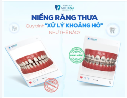 NIỀNG RĂNG THƯA: QUY TRÌNH "XỬ LÝ KHOẢNG HỞ" DỄ DÀNG HƠN BẠN NGHĨ!