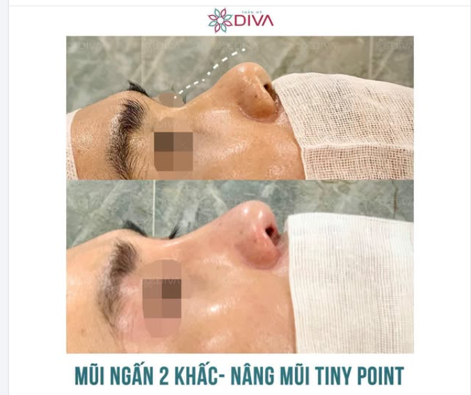 MŨI GÃY GẬP GHỀNH - CẢI THIỆN NHANH CHÓNG NHỜ NÂNG MŨI TINY POINT
