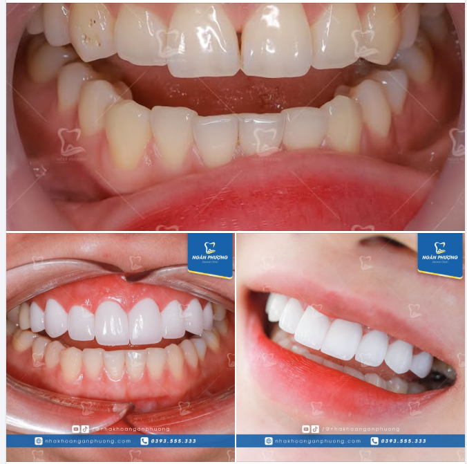 Có thể cải thiện tam giác đen bằng cách nào?