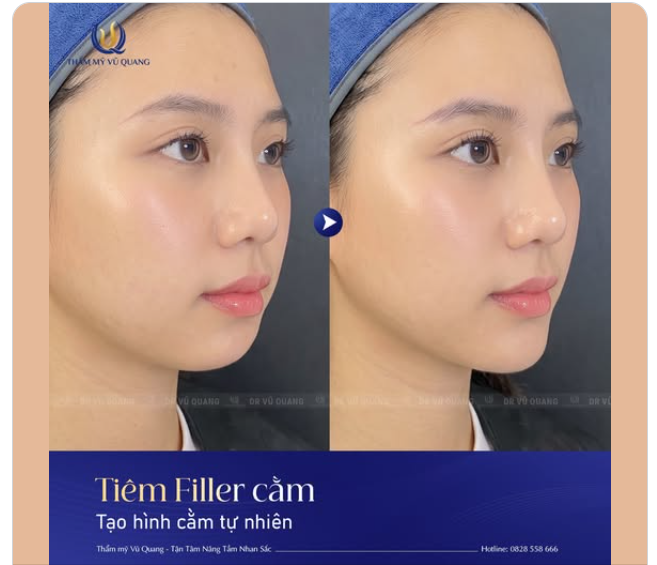 CẰM V-LINE TỰ NHIÊN - TỶ LỆ VÀNG CHO GƯƠNG MẶT HÀI HÒA
