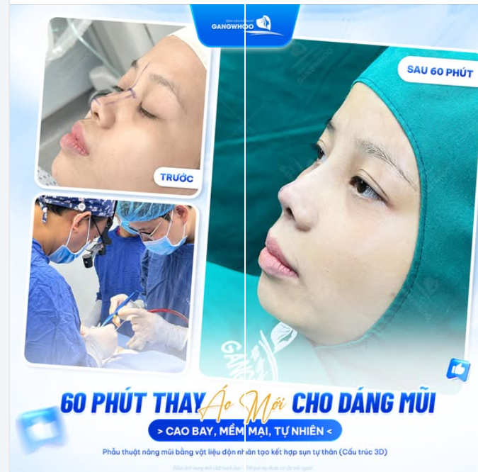 60 PHÚT THAY ĐỔI "ÁO MỚI" CHO DÁNG MŨI