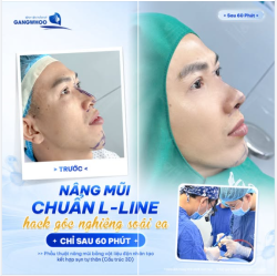 NÂNG MŨI CHUẨN DÁNG L-LINE CHO NAM GIỚI
