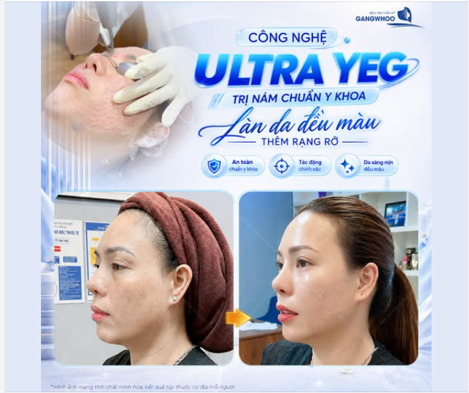 ULTRA YEG – CÔNG NGHỆ TRỊ NÁM CHUẨN Y KHOA