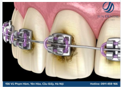 NIỀNG RĂNG ĐẸP – ĐỪNG QUÊN CHĂM SÓC RĂNG ĐÚNG CÁCH!