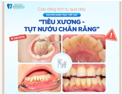 CẢNH BÁO KHẨN: CAO RĂNG DÀY ĐẶC – ĐỪNG ĐỂ "TIÊU XƯƠNG, TỤT NƯỚU" CƯỚP ĐI NỤ CƯỜI CỦA BẠN