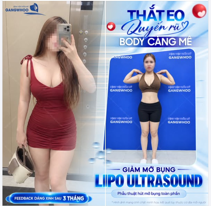 THẮT EO QUYẾN RŨ, BODY CÀNG MÊ - FEEDBACK DÁNG XINH SAU 3 THÁNG GIẢM MỠ BỤNG LIPO ULTRASOUND