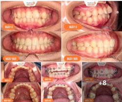 Nhật ký hơn 2 năm niềng răng của một bạn 2K8, từ những ngày đầu còn khấp khểnh đến khi tháo niềng ngay trước ngưỡng cửa đại học.
