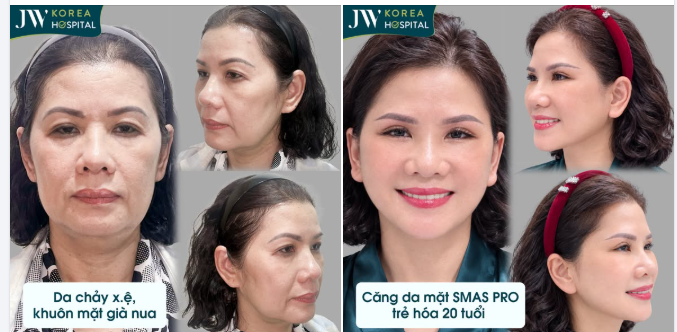 VIỆT KIỀU MỸ VỀ VIỆT NAM CĂNG DA MẶT SMAS PRO – TRẺ HÓA, “XÓA GIÀ”, HỌ HÀNG NHẬN KHÔNG RA