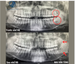 RĂNG KHÔN SÁT THẦN KINH – CA KHÓ CẦN XỬ LÝ THẬT CẨN THẬN