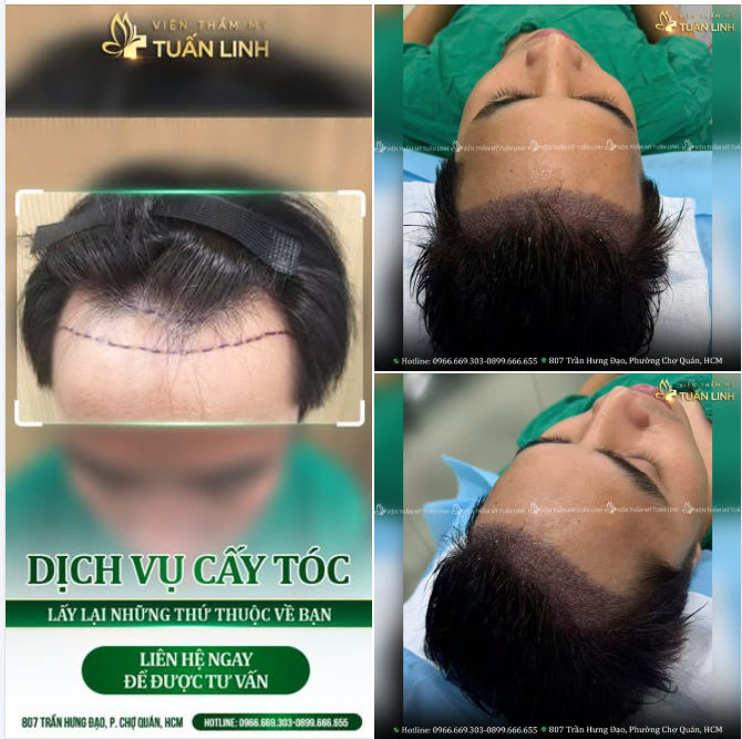 CẤY TÓC NAM – LẤY LẠI NHỮNG THỨ THUỘC VỀ BẠN