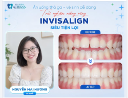 CHÚC MỪNG CHỊ MAI HƯƠNG (32 TUỔI) HOÀN THÀNH HÀNH TRÌNH INVISALIGN – ĐÓN NỤ CƯỜI RẠNG RỠ!