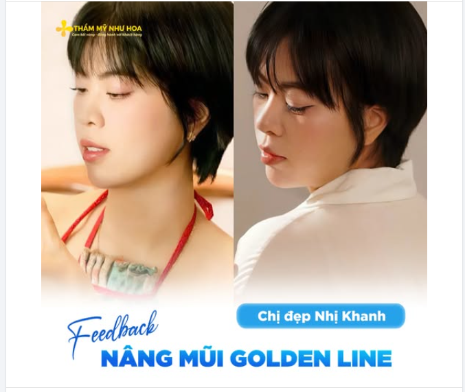 Trước đây, chị đẹp Nhị Khanh mong muốn cải thiện dáng mũi để gương mặt thêm hài hòa, đường nét rõ ràng hơn nhưng vẫn giữ được vẻ tự nhiên vốn có.