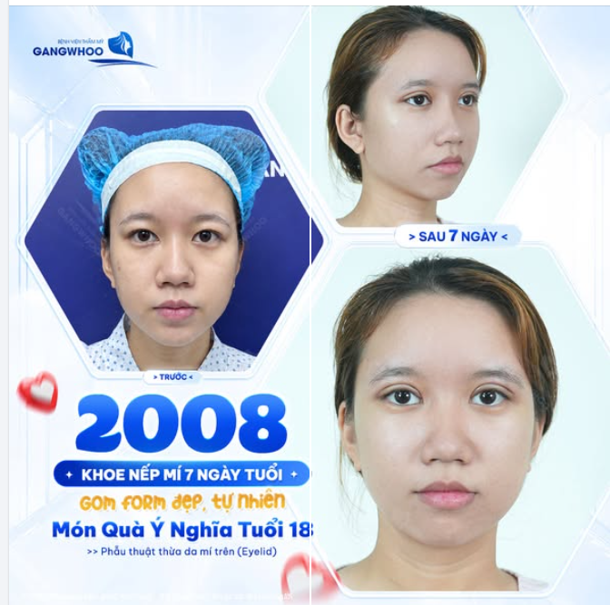 CÔ NÀNG 2008 KHOE NẾP MÍ 7 NGÀY TUỔI