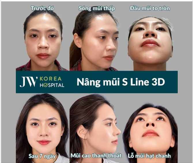 CÔ GÁI 9X SÀI THÀNH XOÁ BỎ 20 NĂM MẶC CẢM VÌ MŨI TO ĐẾN JW NÂNG MŨI S LINE 3D KHIẾN AI NHÌN CŨNG ĐÊ MÊ