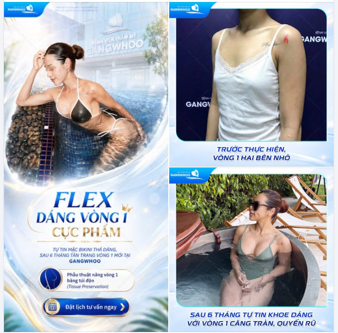 FLEX DÁNG VÒNG 1 CỰC PHẨM - TỰ TIN MẶC BIKINI THẢ DÁNG, SAU 6 THÁNG TÂN TRANG VÒNG 1 MỚI TẠI GANGWHOO