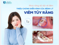 NHỨC RĂNG DỮ DỘI VỀ ĐÊM: DẤU HIỆU CẢNH BÁO BỆNH LÝ VIÊM TỦY RĂNG!