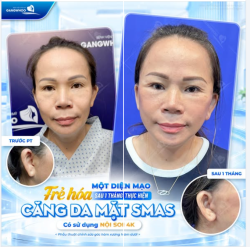 MỘT DIỆN MẠO TRẺ HOÁ SAU 1 THÁNG THỰC HIỆN
