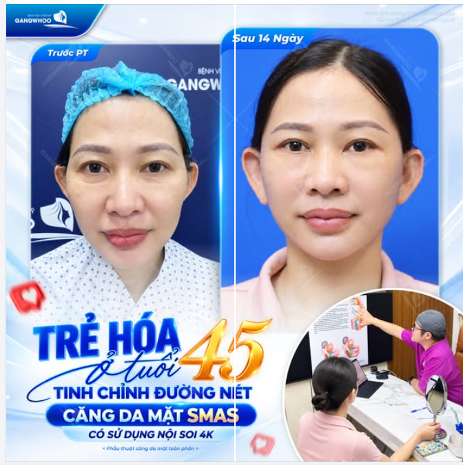 TRẺ HÓA Ở TUỔI 45 - TINH CHỈNH ĐƯỜNG NÉT