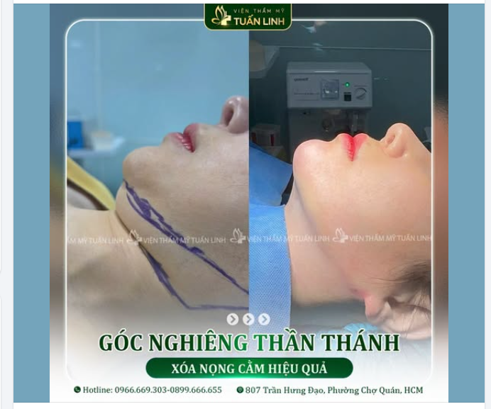 HÚT MỠ NỌNG CẰM – THON GỌN GƯƠNG MẶT, TẠO GÓC NGHIÊNG THẦN THÁNH