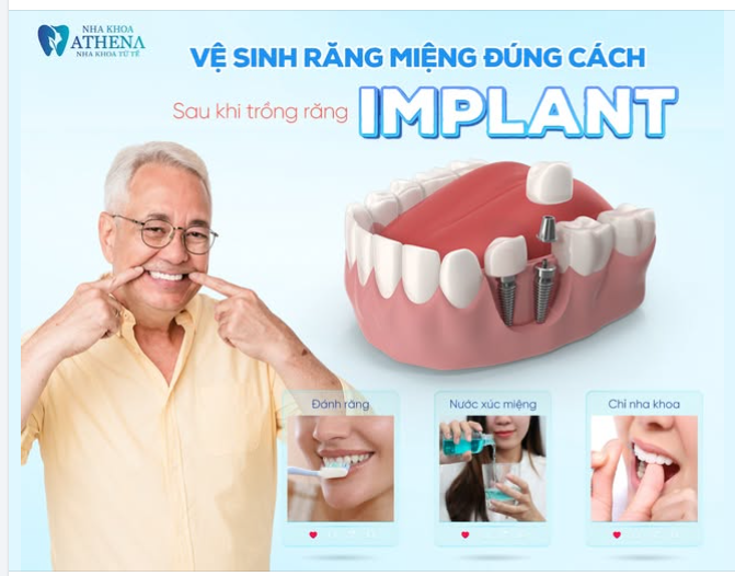VỆ SINH RĂNG MIỆNG ĐÚNG CÁCH SAU KHU TRỒNG RĂNG IMPLANT!