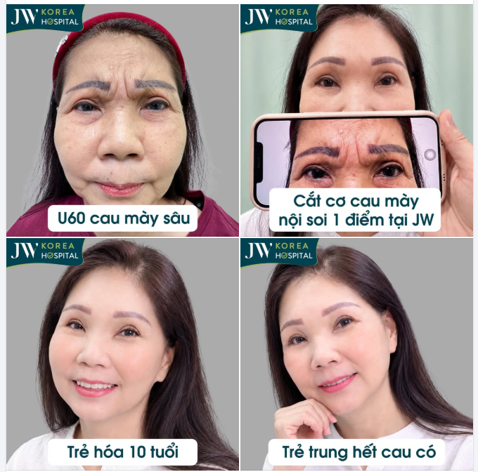 QUÝ CÔ U60 TP.HCM TÌM BÁC SĨ TÚ DUNG XÓA RÃNH CAU MÀY, TRẺ 10 TUỔI, HẾT CAU CÓ CHỈ SAU 60 PHÚT TẠI JW