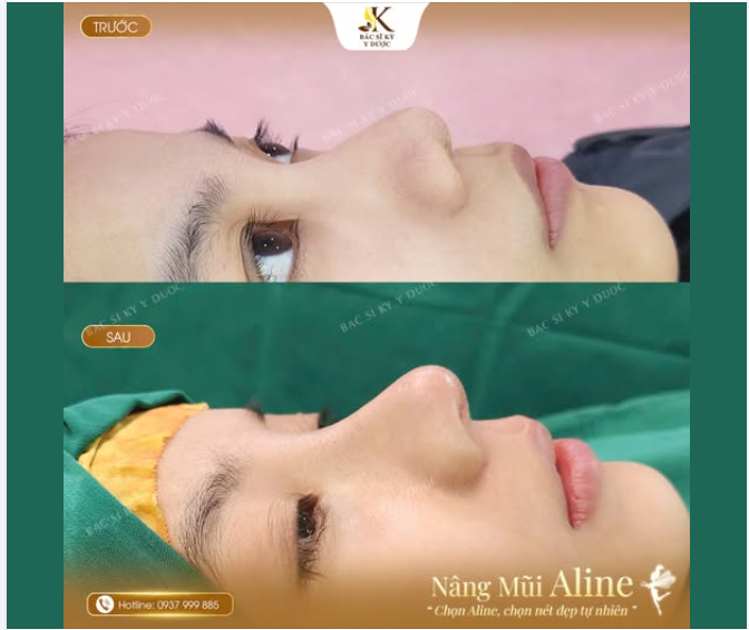 NÂNG MŨI ALINE – ĐẸP HÀI HÒA, TỰ NHIÊN HƠN
