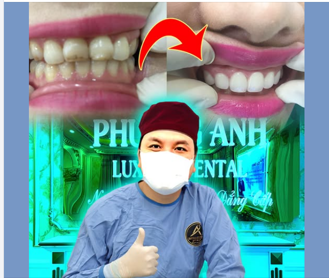Cách chọn màu răng sứ tự nhiên nhất dựa vào màu lòng mắt