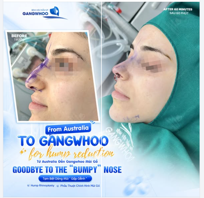 Một chiếc mũi có phần gồ rõ trên sống mũi có thể khiến đường nét góc nghiêng trở nên kém thanh thoát, tổng thể khuôn mặt mất đi sự hài hòa vốn có.