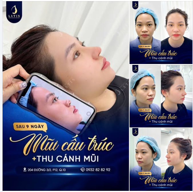 9 NGÀY “NÂNG LEVEL” GÓC NGHIÊNG – MŨI CẤU TRÚC + THU CÁNH MŨI VÀO PHOM RÕ NÉT