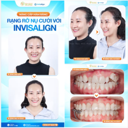 Niềng răng không sợ lộ mắc cài khi đã có Invisalign