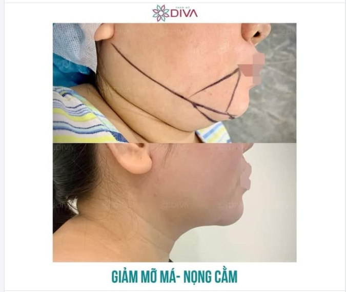 Giảm mỡ nọng cằm bằng cách nào thì hiệu quả?