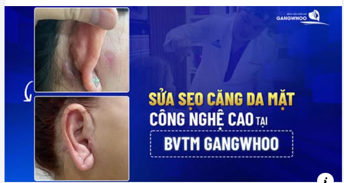 SỬA SẸO CĂNG DA MẶT – GIẢI PHÁP CẢI THIỆN SẸO, TỰ TIN LẤY LẠI NÉT ĐẸP KHUÔN MẶT 