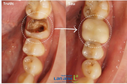 Đầu tuần, học sinh háo hức tựu trường… còn chiếc răng này cũng “tựu trường” với diện mạo mới!